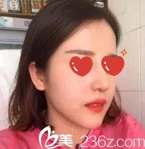 做鼻综合+假体垫下巴术后半个月 做鼻综合+假体垫下巴术后半个月