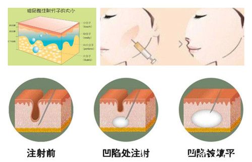 玻尿酸填充泪沟流程