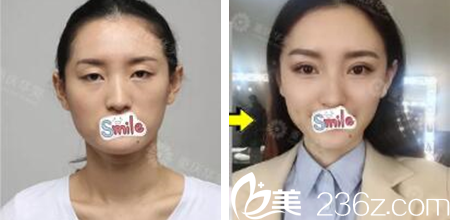 重庆华美张国强双眼皮案例 重庆华美张国强双眼皮案例