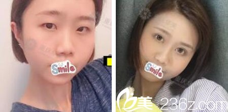 重庆华美张国强做双眼皮怎么样 重庆华美张国强做双眼皮怎么样