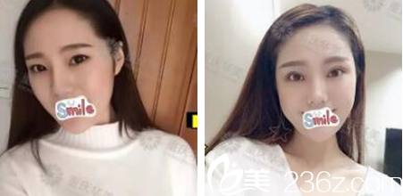重庆华美李富强做双眼皮效果怎么样 重庆华美李富强做双眼皮效果怎么样
