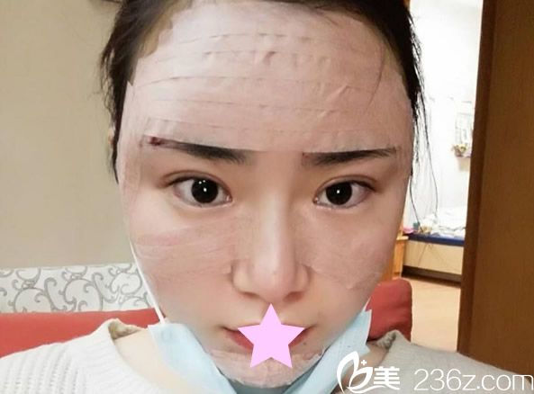 自体脂肪填充全脸天 自体脂肪填充全脸天