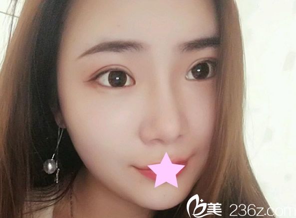 全脸脂肪填充第15天照片 全脸脂肪填充第15天照片