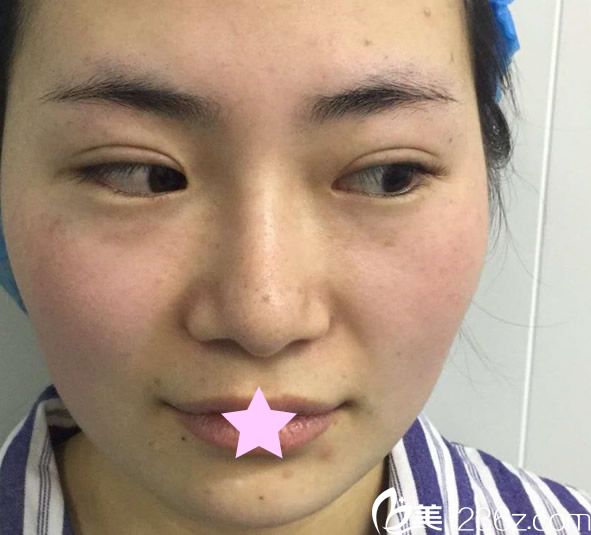 呼和浩特大韩整形医院自体脂肪填充全脸前 呼和浩特大韩整形医院自体脂肪填充全脸前