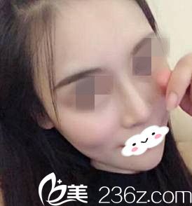 我在整形医院做的假体隆鼻术后一个月，轻松拥有了自然的小翘鼻