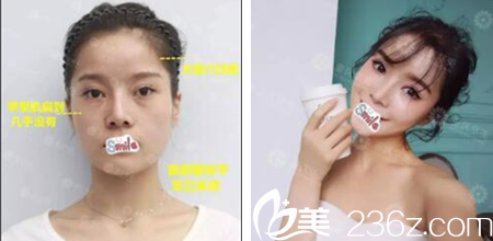 重庆华美李富强自体脂肪面部填充案例 重庆华美李富强自体脂肪面部填充案例