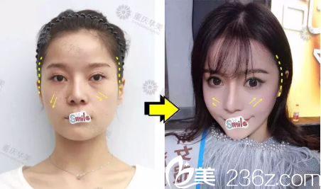 李富强自体脂肪全脸填充案例 李富强自体脂肪全脸填充案例