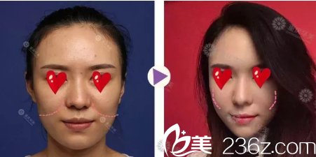 重庆华美脂肪填充苹果肌案例 重庆华美脂肪填充苹果肌案例