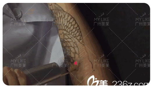 广州美莱超皮秒洗纹身过程图