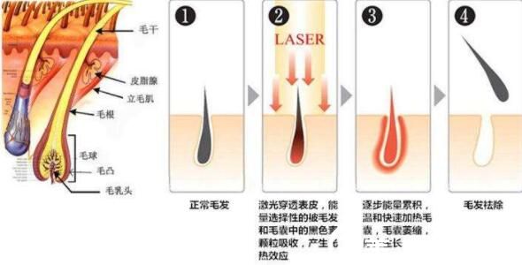 超冰的脱毛手术原理