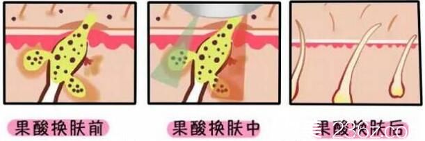 果酸换肤前后对比 果酸换肤前后对比
