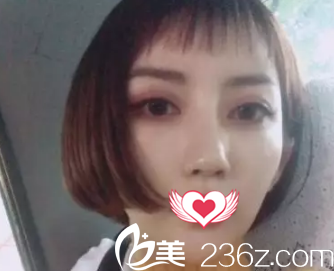 术后10天鼻子消肿很多 术后10天鼻子消肿很多