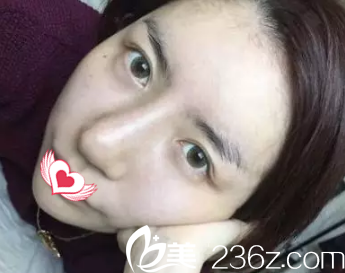 假体隆鼻失败鼻头宽大鼻梁歪斜 假体隆鼻失败鼻头宽大鼻梁歪斜