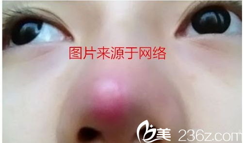 假体垫鼻尖可能出现的鼻尖发红