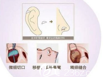 自体耳软骨垫鼻尖