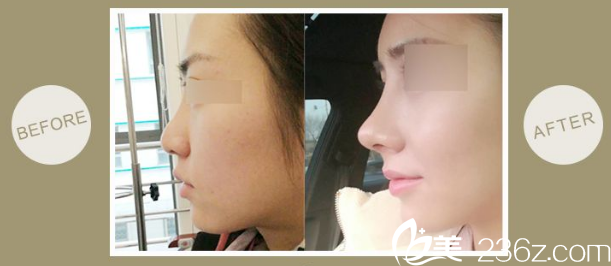 做鼻尖选择用自体软骨做前后对比案例