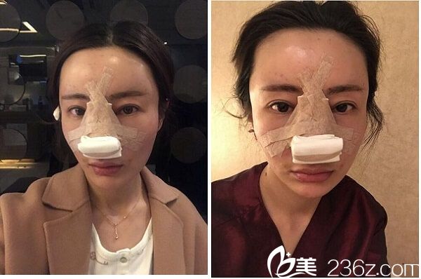 在韩国碧夏整形做完手术后当天 在韩国碧夏整形做完手术后当天