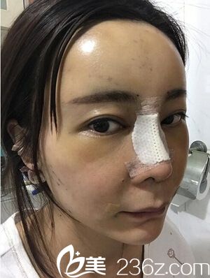 自体软骨隆鼻2天了 自体软骨隆鼻2天了