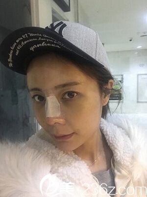 自体脂肪填充全脸后3天 自体脂肪填充全脸后3天