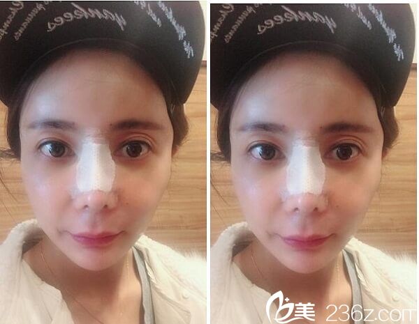 隆鼻后4天恢复效果 隆鼻后4天恢复效果