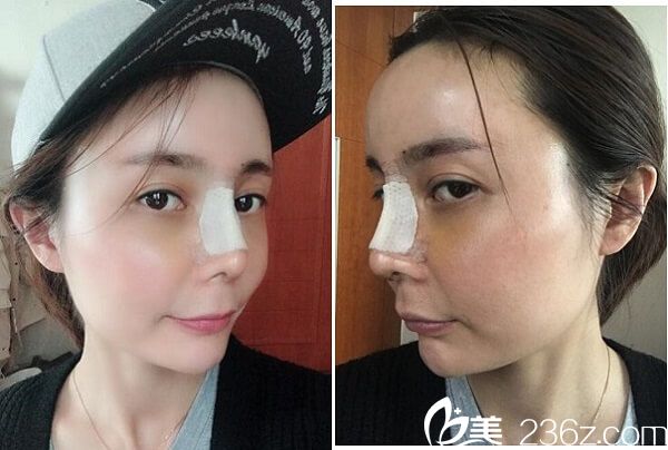 在韩国碧夏整形做自体 软骨隆鼻5天了 在韩国碧夏整形做自体 软骨隆鼻5天了