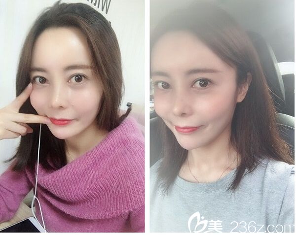 自体软骨+自体脂肪填充全脸后22天 自体软骨+自体脂肪填充全脸后22天