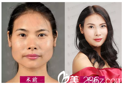广州华美瘦脸案例对比图