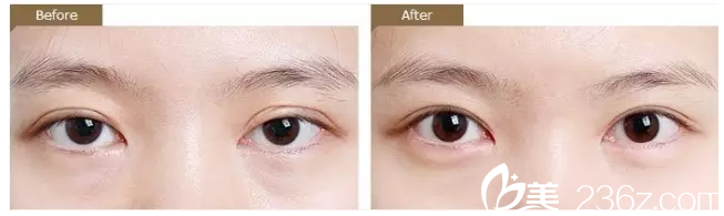 双眼皮不对称修复案例 双眼皮不对称修复案例