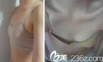 我在太原华美整形医院做假体隆胸前照片 我在太原华美整形医院做假体隆胸前照片