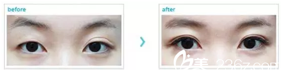 双眼皮不对称?太宽?埋线消失?你正在遭受的术后失败到南通维多利亚都有修复案例可提前看效果