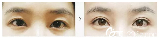 双眼皮消失做修复案例 双眼皮消失做修复案例
