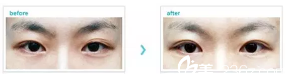 三眼皮修复案例 三眼皮修复案例