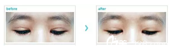 严重疤痕做双眼皮修复案例 严重疤痕做双眼皮修复案例