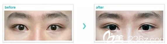 重睑线较短做修复案例 重睑线较短做修复案例