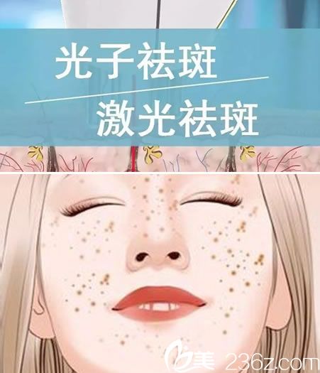 光子祛斑与激光祛斑的区别