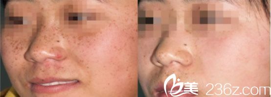 光子祛斑案例效果对比图