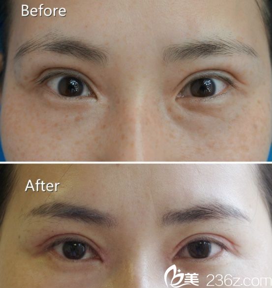 激光祛斑真人案例效果对比图