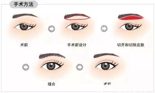 直接切眉术过程示意图