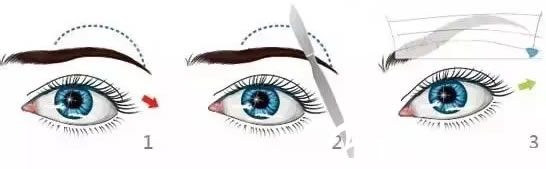 常规拉皮切眉术过程示意图
