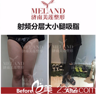 济南美莲(原美莱)医疗美容医院吸脂案例 济南美莲(原美莱)医疗美容医院吸脂案例