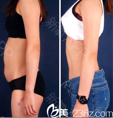 <!--<i data=20240703-sp></li>
<li><i data=20240703-sp></i>-->整形美容医院抽脂案例