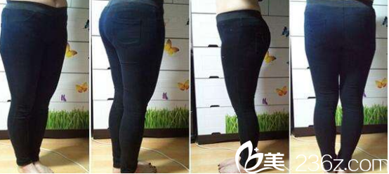 济南海峡美容整形医院吸脂案例 济南海峡美容整形医院吸脂案例