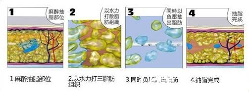 水动力吸脂原理