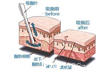 水动力吸脂手术