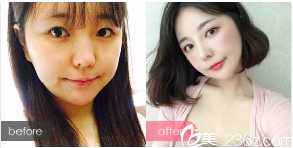 江门华美整形医院毛孝忠做的鼻综合隆鼻案例 江门华美整形医院毛孝忠做的鼻综合隆鼻案例