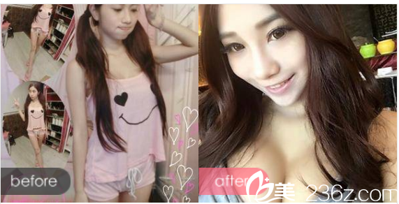 江门华美整形医院毛孝忠做的自体脂肪隆胸案例对比图 江门华美整形医院毛孝忠做的自体脂肪隆胸案例对比图