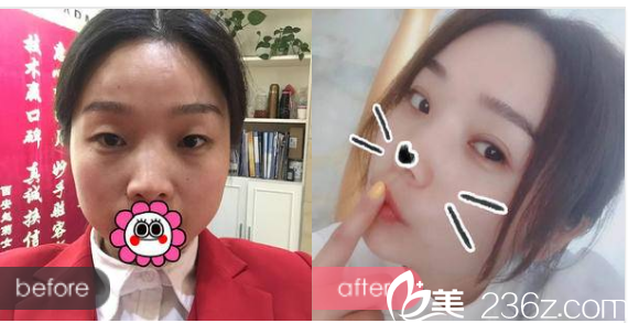 江门华美整形医院常海做的双眼皮案例 江门华美整形医院常海做的双眼皮案例