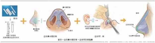 隆鼻假体取出可以放新的假体吗？