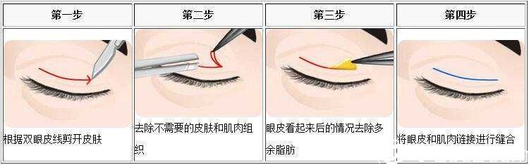 切开双眼皮手术原理