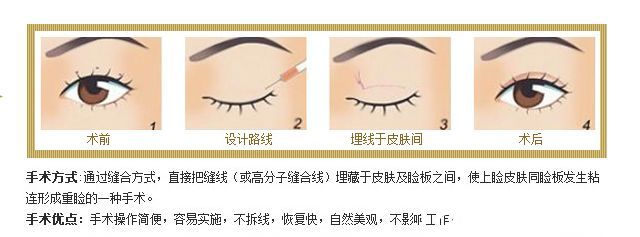 埋线双眼皮手术原理